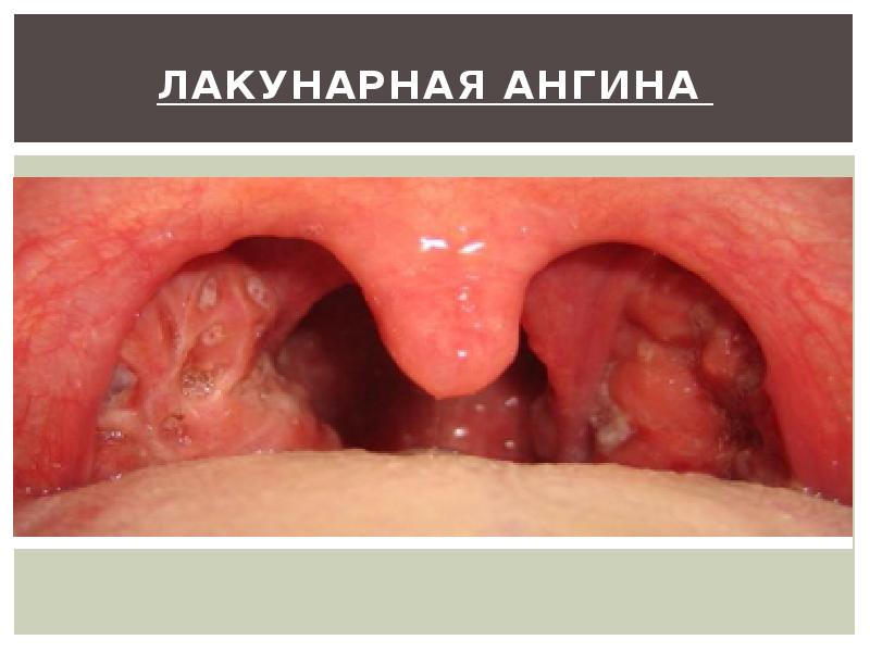 Лакунарная ангина Лакунарная ангина