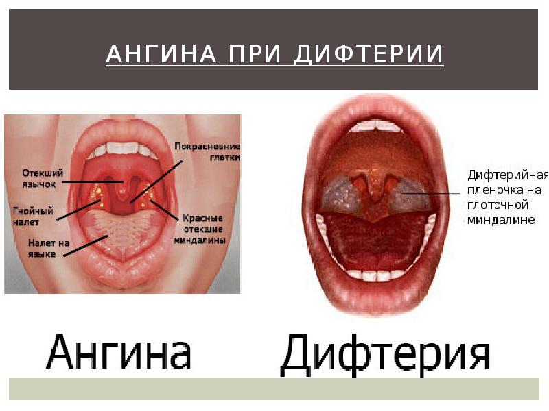 Ангина при дифтерии Ангина при дифтерии