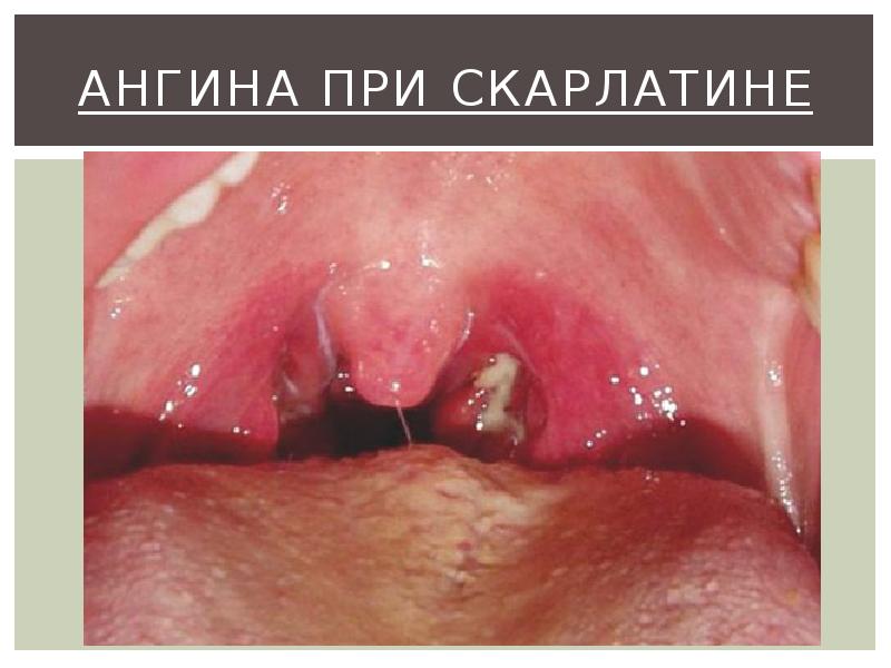 Ангина при скарлатине Ангина при скарлатине