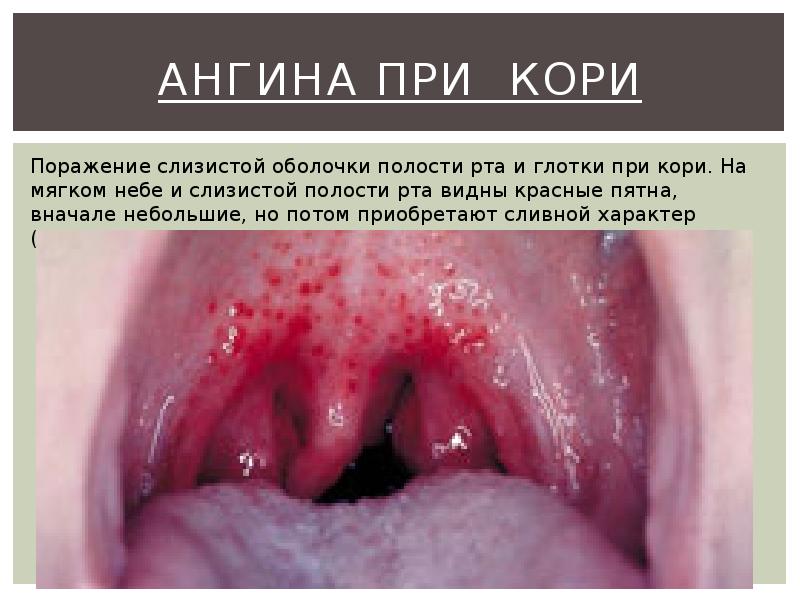Ангина при кори Ангина при кори