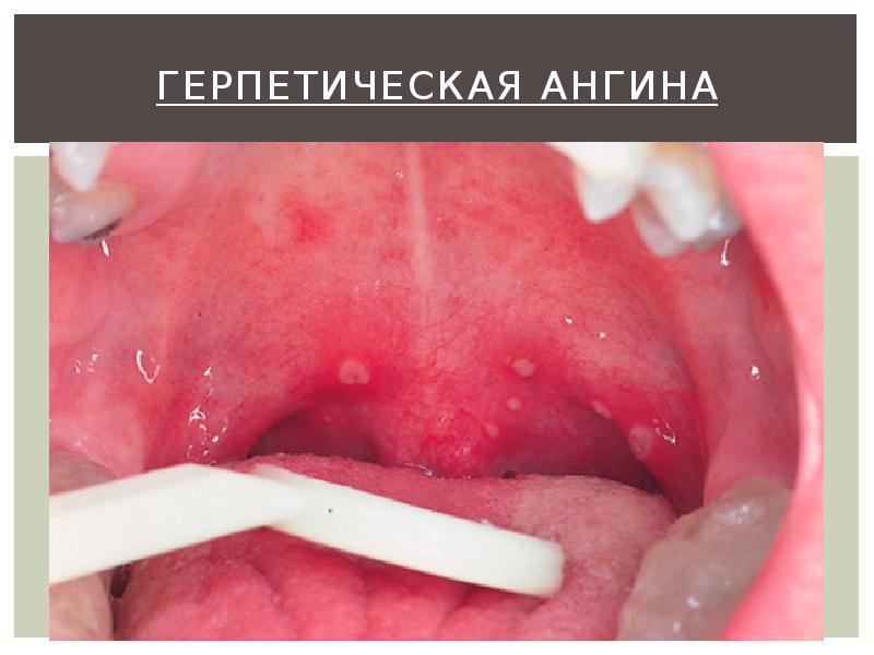 Герпетическая ангина Герпетическая ангина
