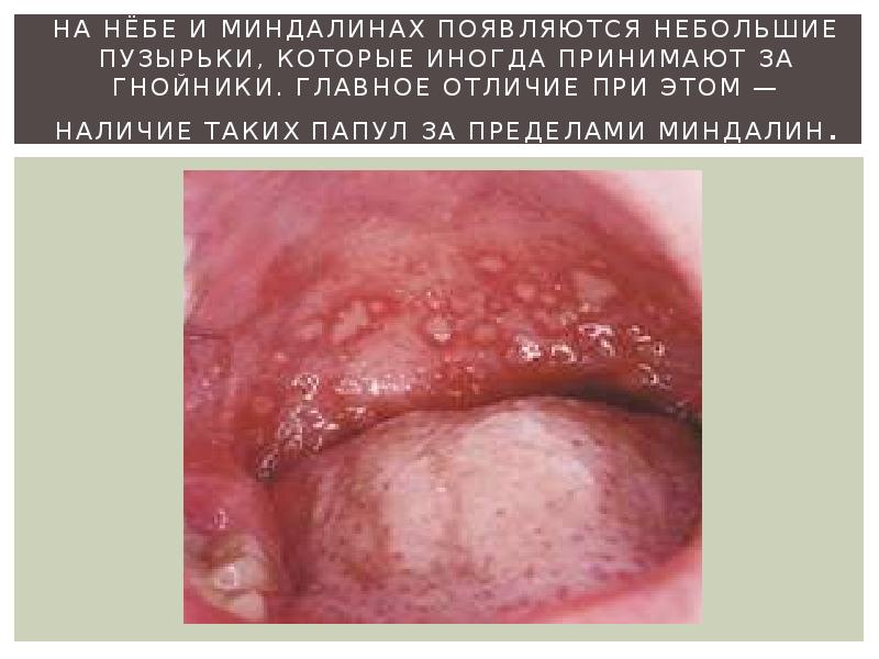 на нёбе и миндалинах появляются небольшие пузырьки, которые иногда принимают за на нёбе и миндалинах появляются небольшие пузырьки, которые иногда принимают за