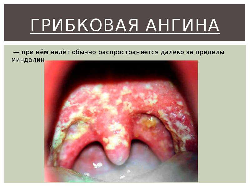 Грибковая ангина Грибковая ангина