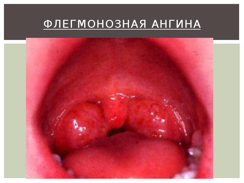 Флегмонозная ангина Флегмонозная ангина