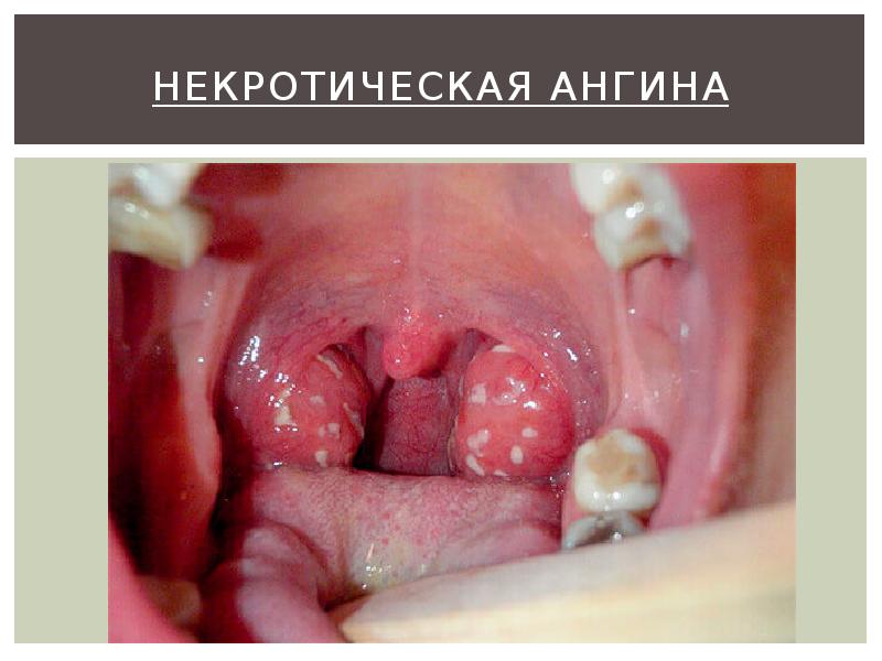 Некротическая ангина Некротическая ангина