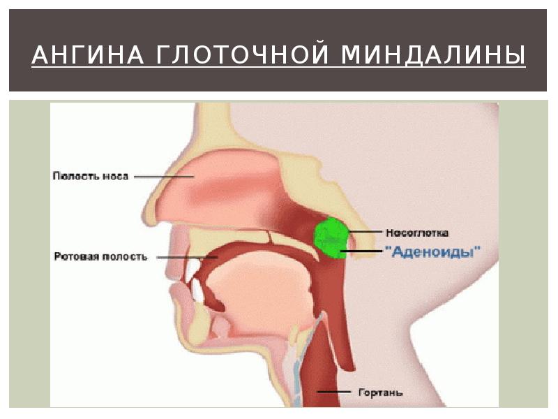 Ангина глоточной миндалины Ангина глоточной миндалины