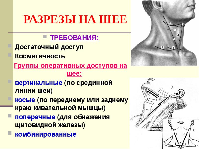 РАЗРЕЗЫ НА ШЕЕ ТРЕБОВАНИЯ: Достаточный доступ Косметичность Группы оперативных доступов на