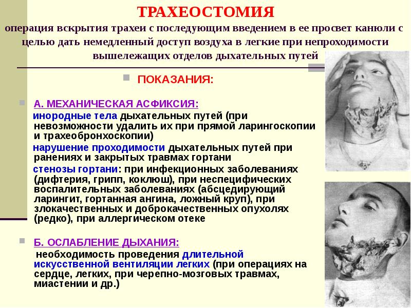 ТРАХЕОСТОМИЯ операция вскрытия трахеи с последующим введением в ее просвет канюли