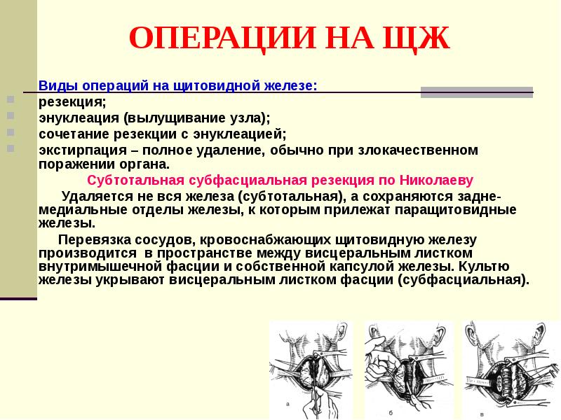 ОПЕРАЦИИ НА ЩЖ 	Виды операций на щитовидной железе: резекция; энуклеация (вылущивание