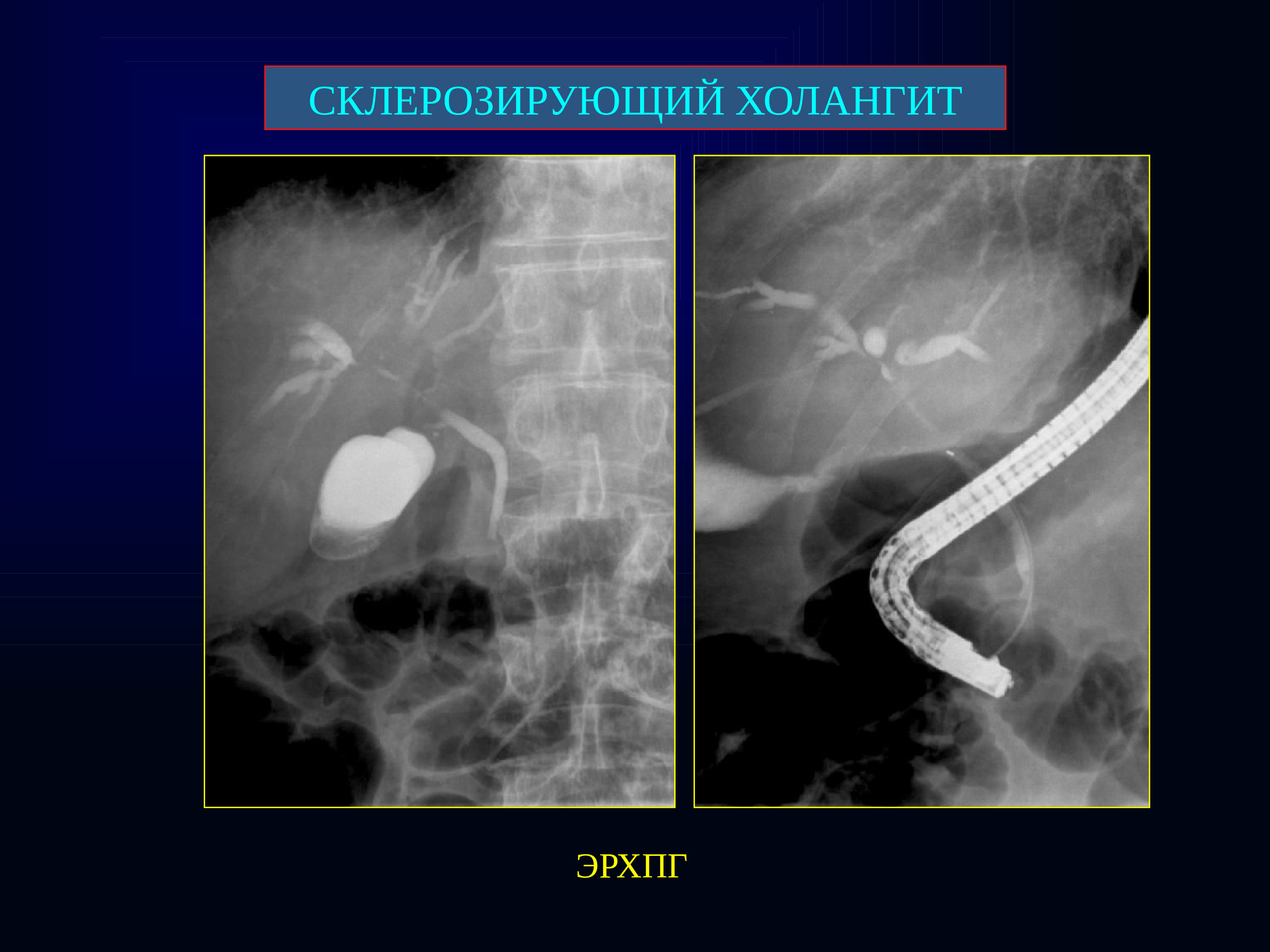 Склерозирующий холангит клинические. Первичный склерозирующий холангит ЭРХПГ. Эндоскопическая ретроградная холангиопанкреатография. Склерозирующий холангит кт. Эндоскопическая ретроградная холангиопанкреатография заключение.