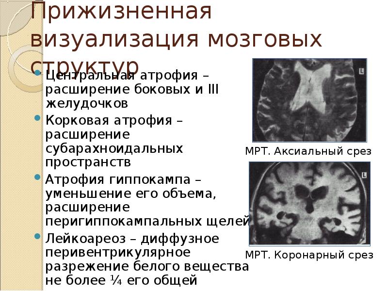 Лейкоареоз головного мозга симптомы. Прижизненная визуализация мозговых структур. Атрофия мозговых структур. Диффузная кортикальная атрофия мрт.