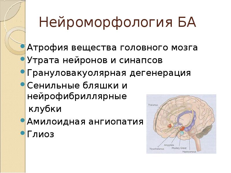 Дегенерация головного. Церебральная амилоидная ангиопатия. Сенильная дегенерация головного мозга. Амилоидные бляшки при болезни Альцгеймера на мрт.