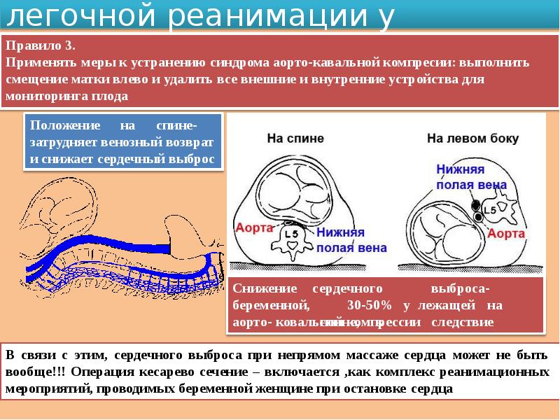 Особенности реанимации у беременных женщин презентация