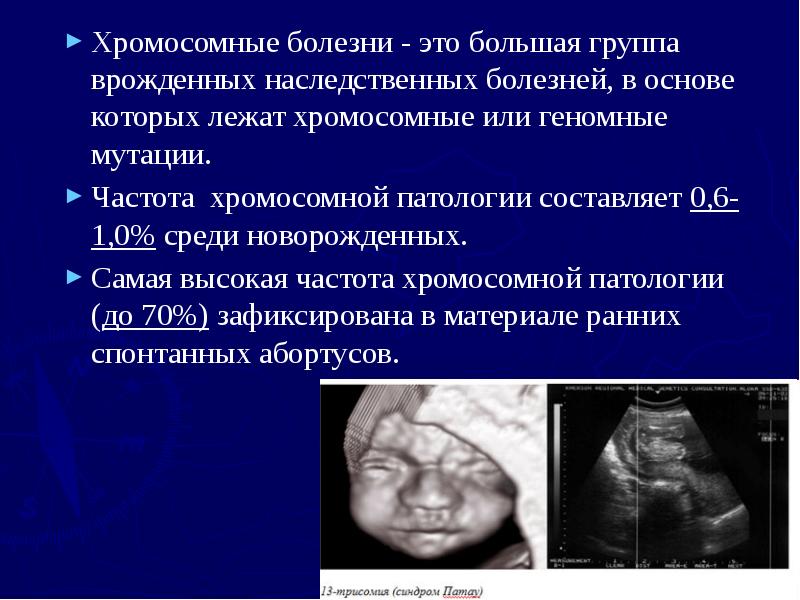 Хромосомные болезни - это большая группа врожденных наследственных болезней, в основе