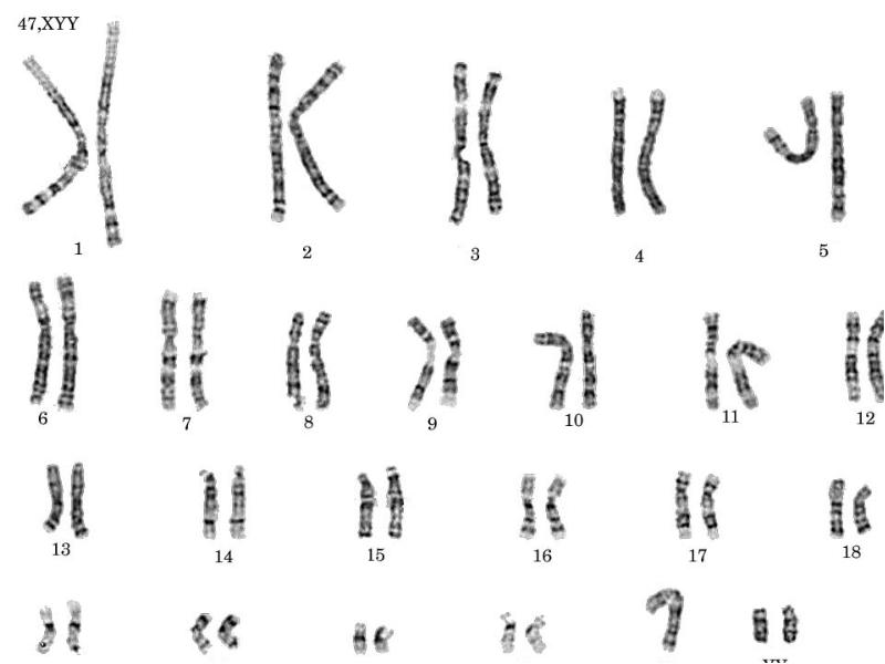 Полисомия по y хромосоме презентация