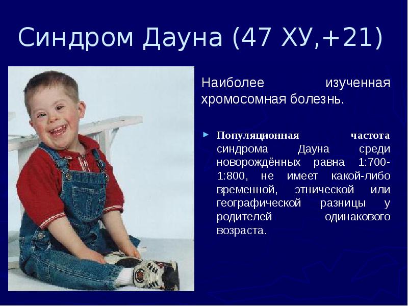 Синдром Дауна (47 ХУ,+21) Наиболее изученная хромосомная болезнь.  Популяционная частота