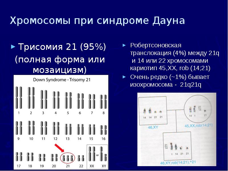 Хромосомы при синдроме Дауна Трисомия 21 (95%) (полная форма или мозаицизм)