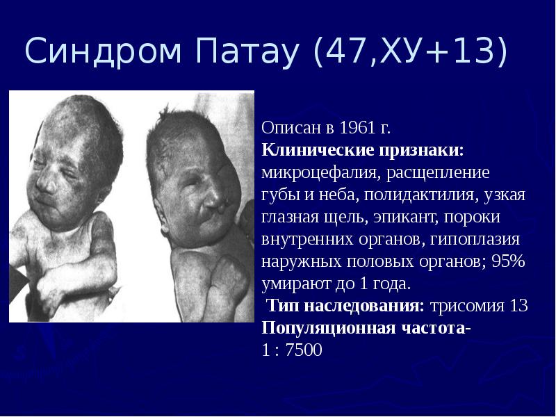 Синдром Патау (47,ХУ+13)