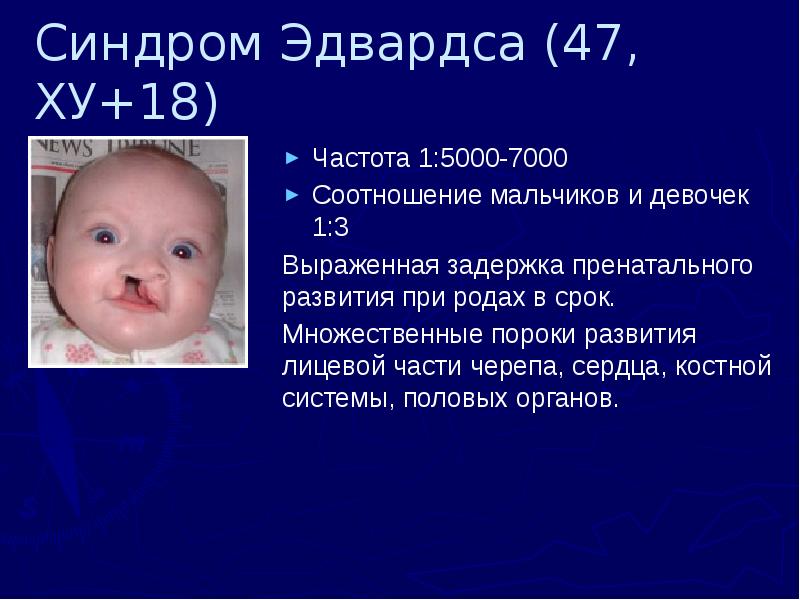 Синдром Эдвардса (47, ХУ+18) Частота 1:5000-7000 Соотношение мальчиков и девочек 1:3