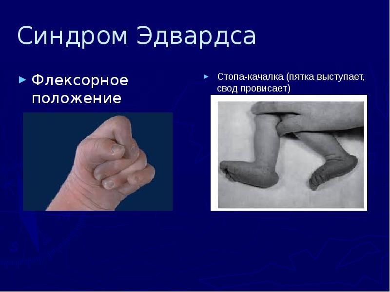 Синдром Эдвардса Флексорное положение пальцев