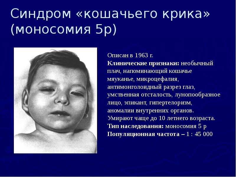 Синдром «кошачьего крика» (моносомия 5р)