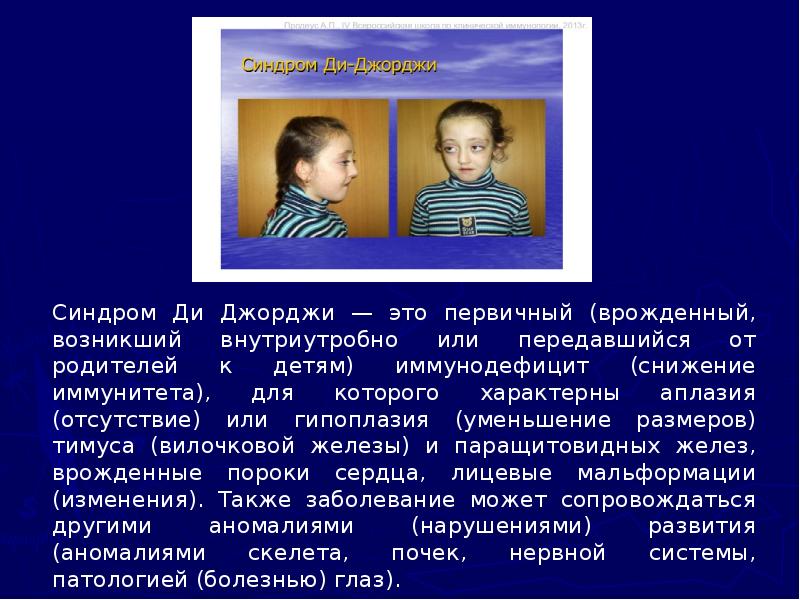 Синдром Ди Джорджи — это первичный (врожденный, возникший внутриутробно или передавшийся