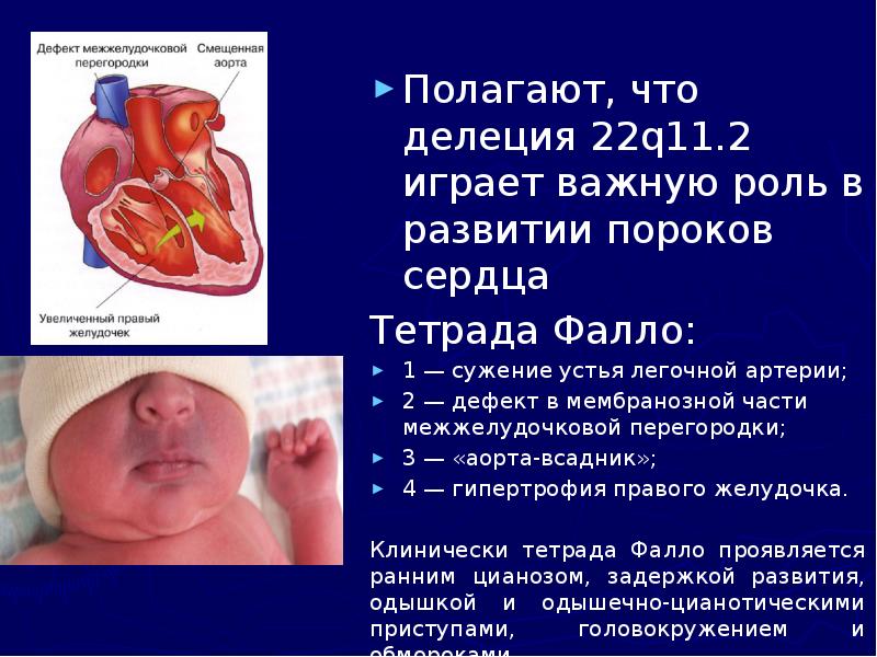 Полагают, что делеция 22q11.2 играет важную роль в развитии пороков сердца