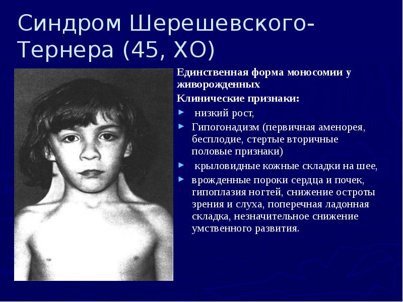 Синдром Шерешевского-Тернера (45, ХО)