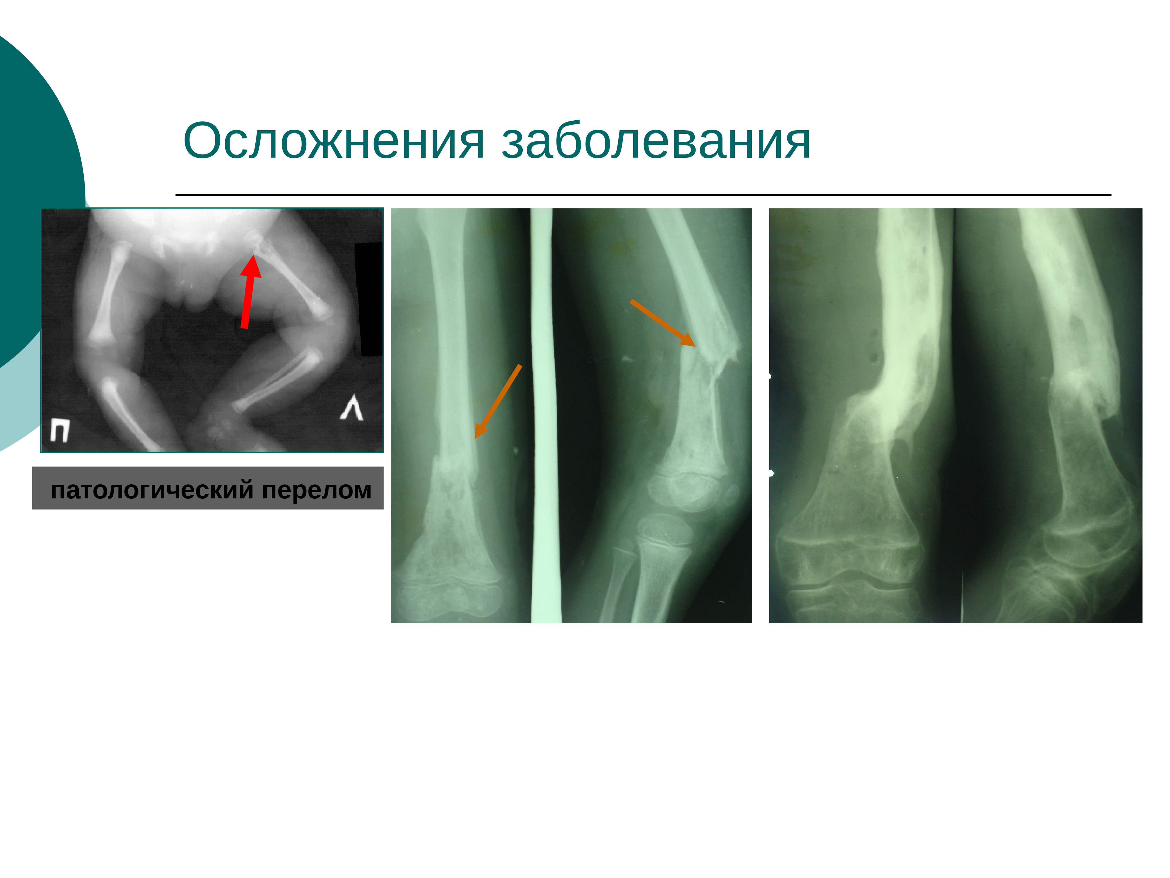 Остеомиелит у детей презентация