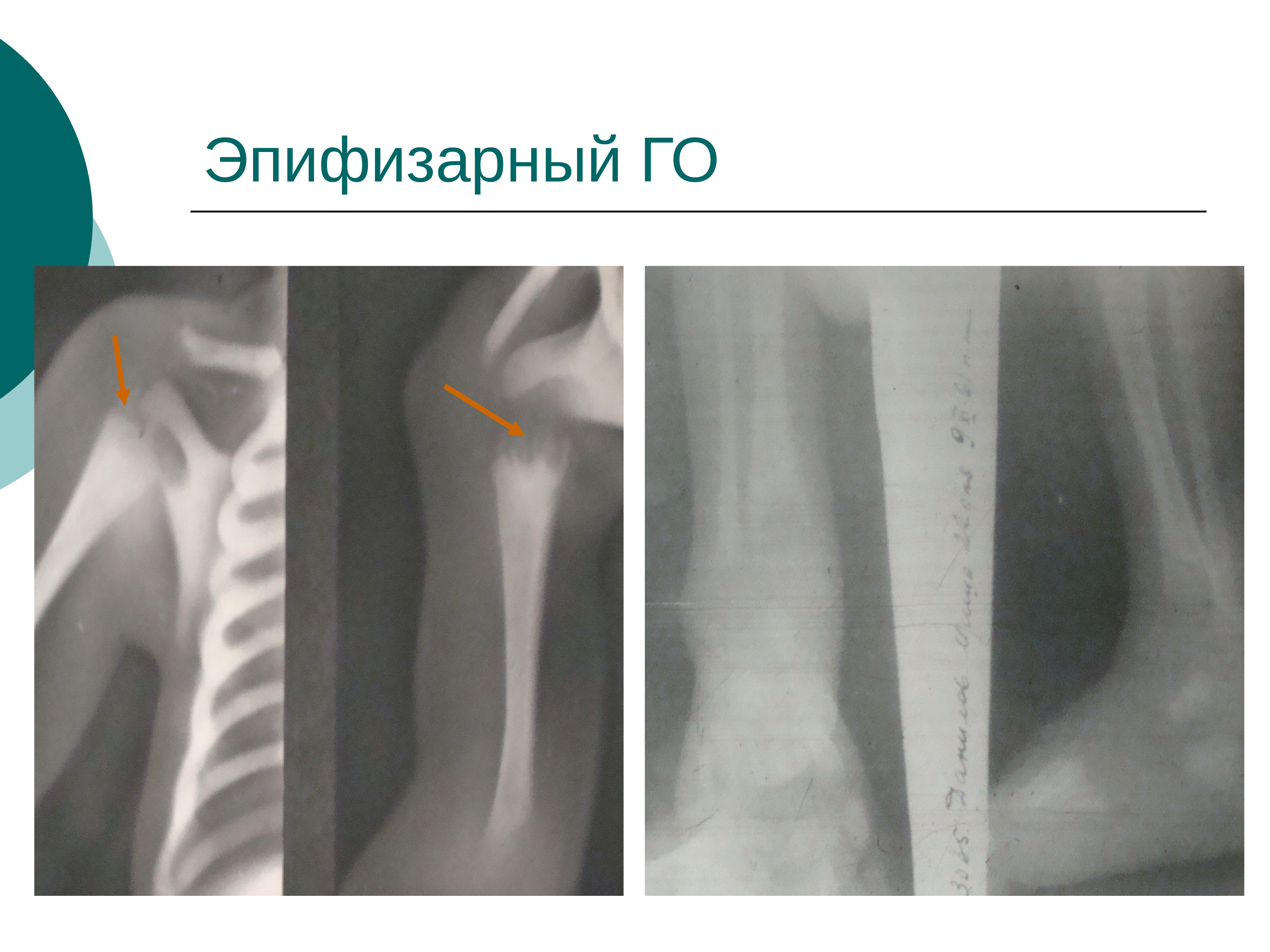 Остеомиелит у детей презентация