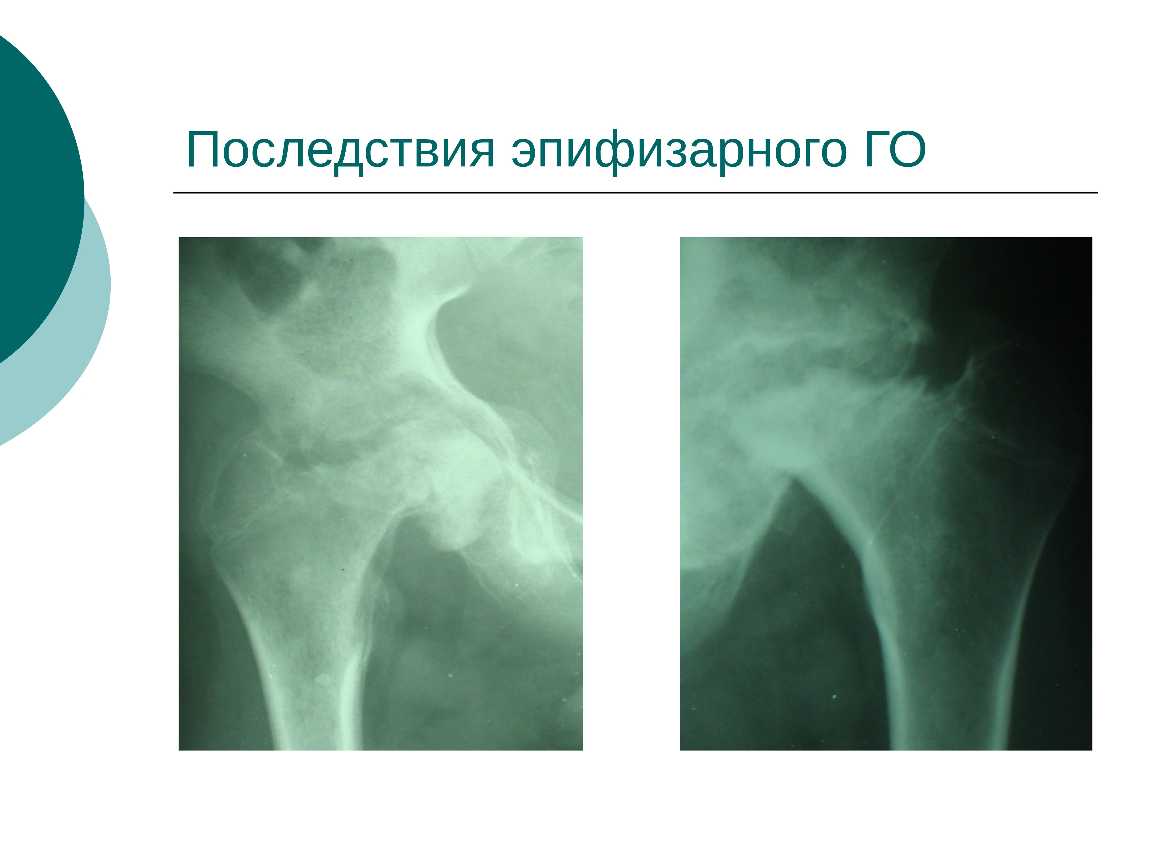 Эпифизарный остеомиелит у детей презентация