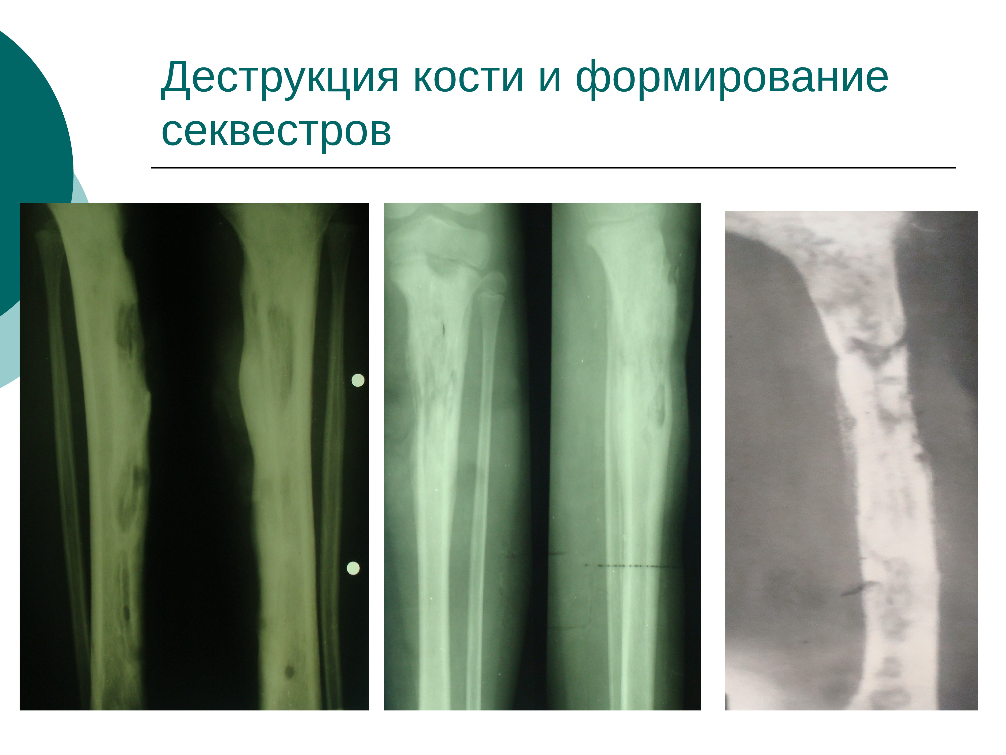 Эпифизарный остеомиелит у детей презентация