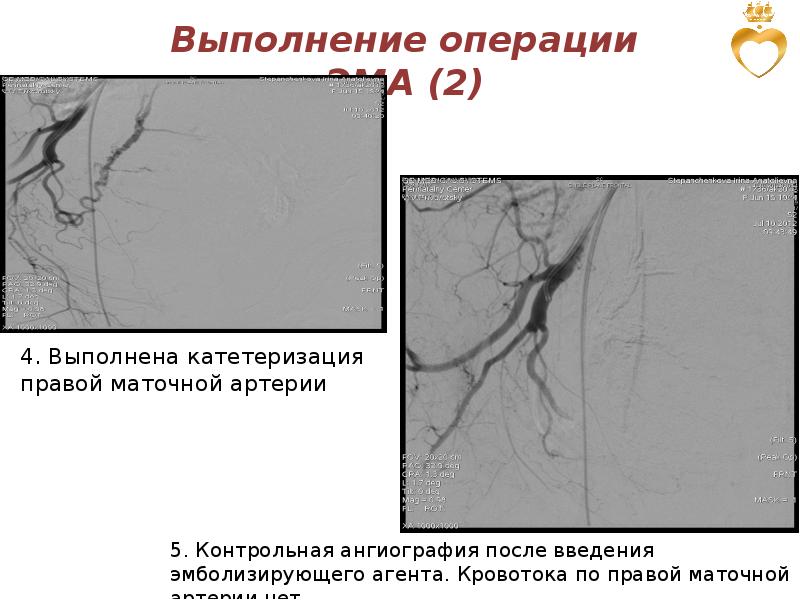 Операция эма после