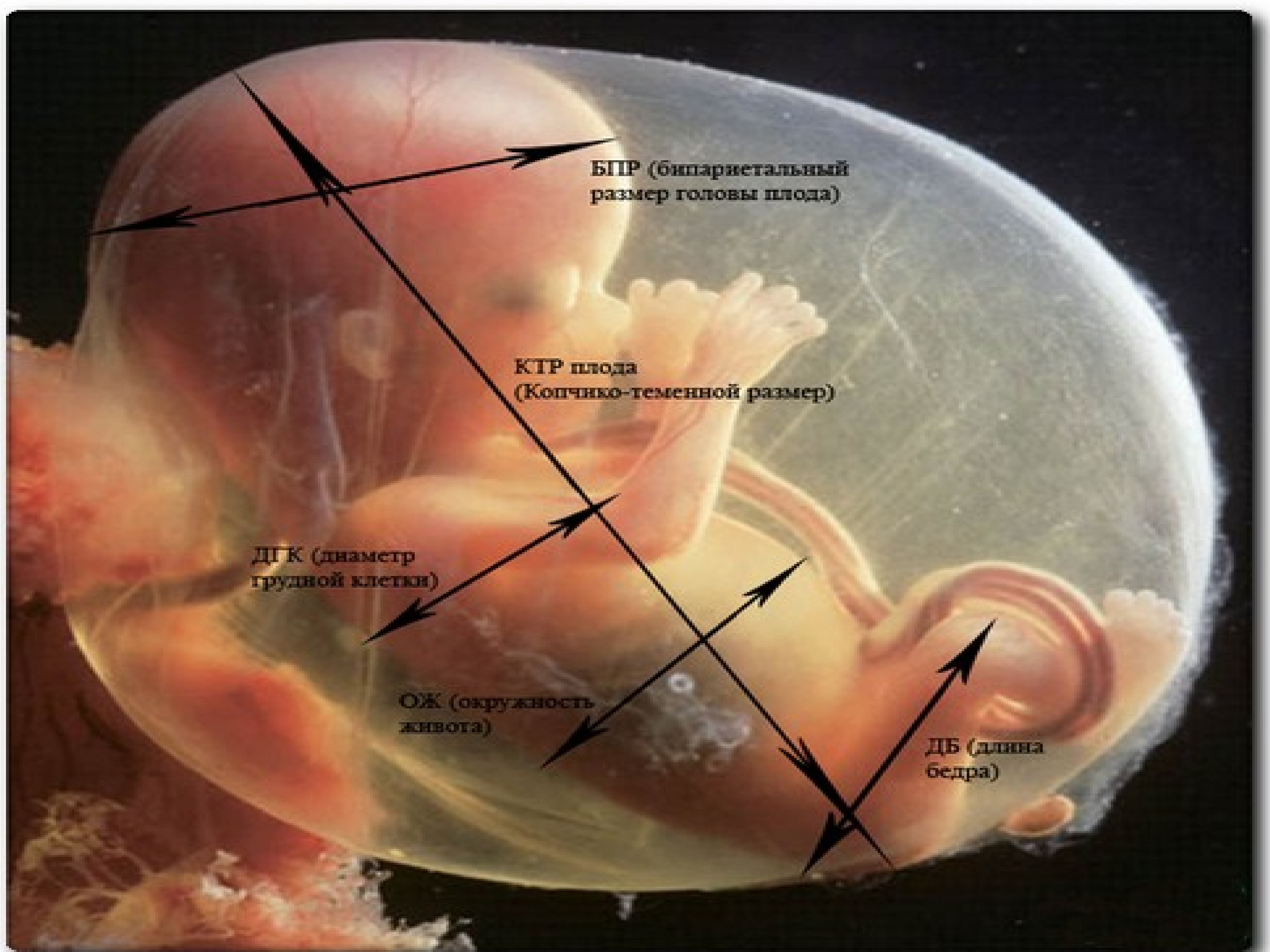 Мозг плода по неделям. БПР бипариетальный размер норма. Бипариетальный размер головки плода норма. Бипариетальный размер по неделям беременности. Копчико-теменной размер эмбриона.