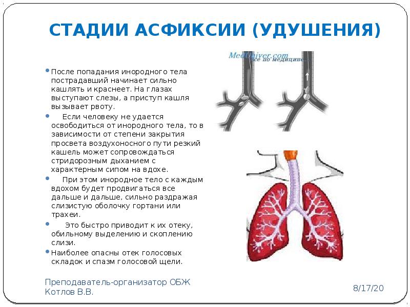 Первая помощь при попадании инородных тел в верхние дыхательные пути презентация