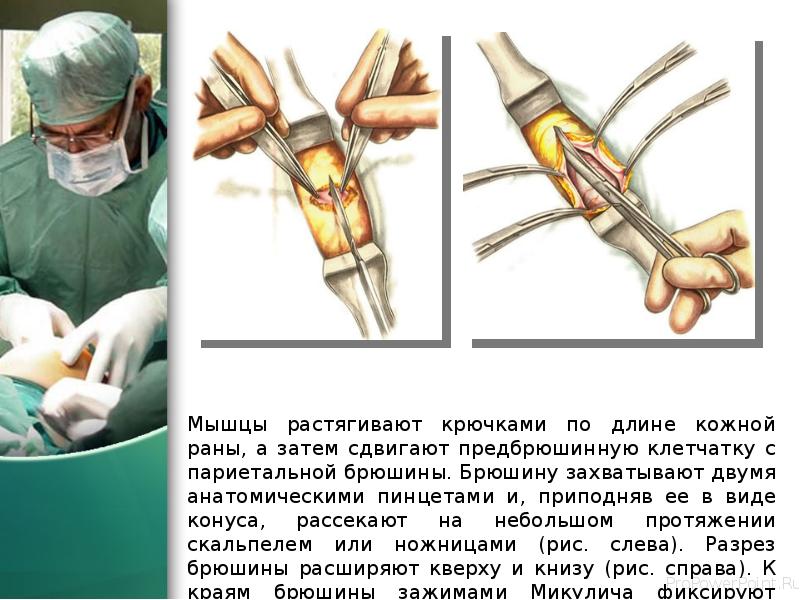 Мышцы растягивают крючками по длине кожной раны, а затем сдвигают предбрюшинную Мышцы растягивают крючками по длине кожной раны, а затем сдвигают предбрюшинную