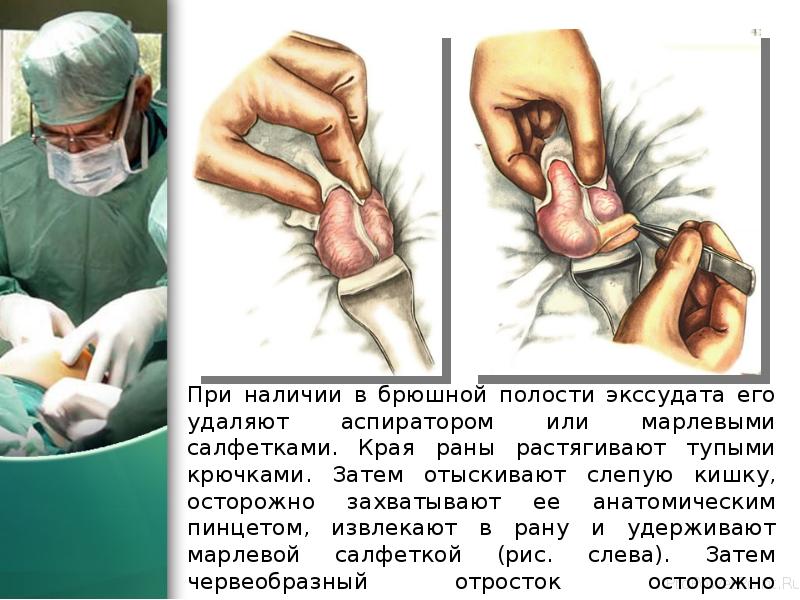При наличии в брюшной полости экссудата его удаляют аспиратором или марлевыми При наличии в брюшной полости экссудата его удаляют аспиратором или марлевыми