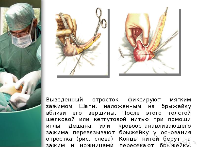 Выведенный отросток фиксируют мягким зажимом Шапи, наложенным на брыжейку вблизи его Выведенный отросток фиксируют мягким зажимом Шапи, наложенным на брыжейку вблизи его