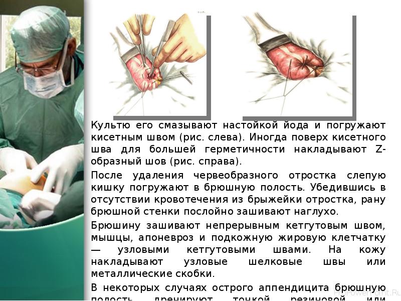 Культю его смазывают настойкой йода и погружают кисетным швом (рис. слева). Культю его смазывают настойкой йода и погружают кисетным швом (рис. слева).
