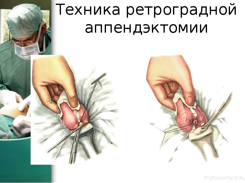 Техника ретроградной аппендэктомии Техника ретроградной аппендэктомии