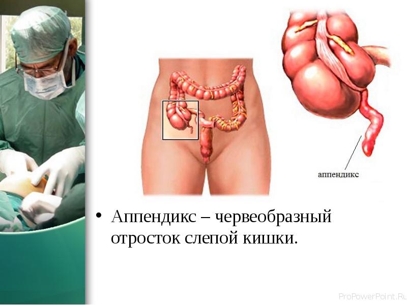 Аппендикс – червеобразный отросток слепой кишки.
Аппендикс – червеобразный отросток слепой Аппендикс – червеобразный отросток слепой кишки.
Аппендикс – червеобразный отросток слепой