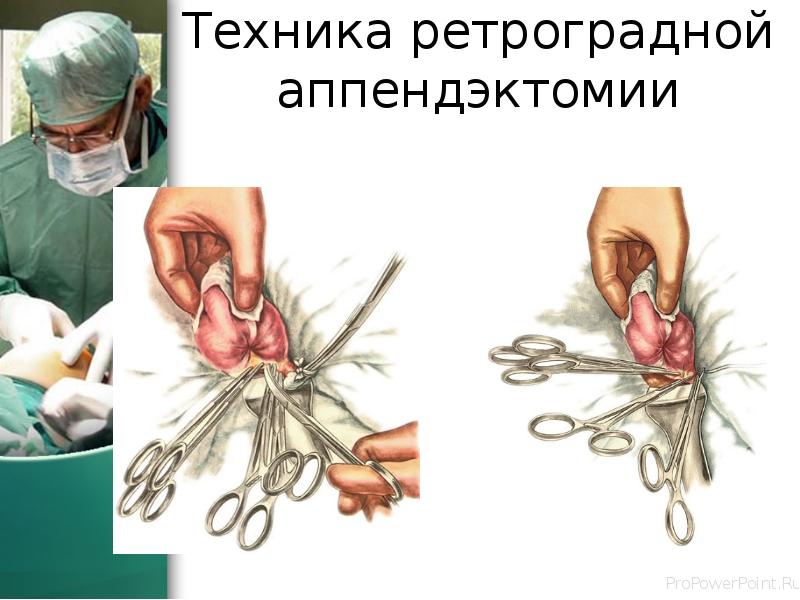 Техника ретроградной аппендэктомии Техника ретроградной аппендэктомии