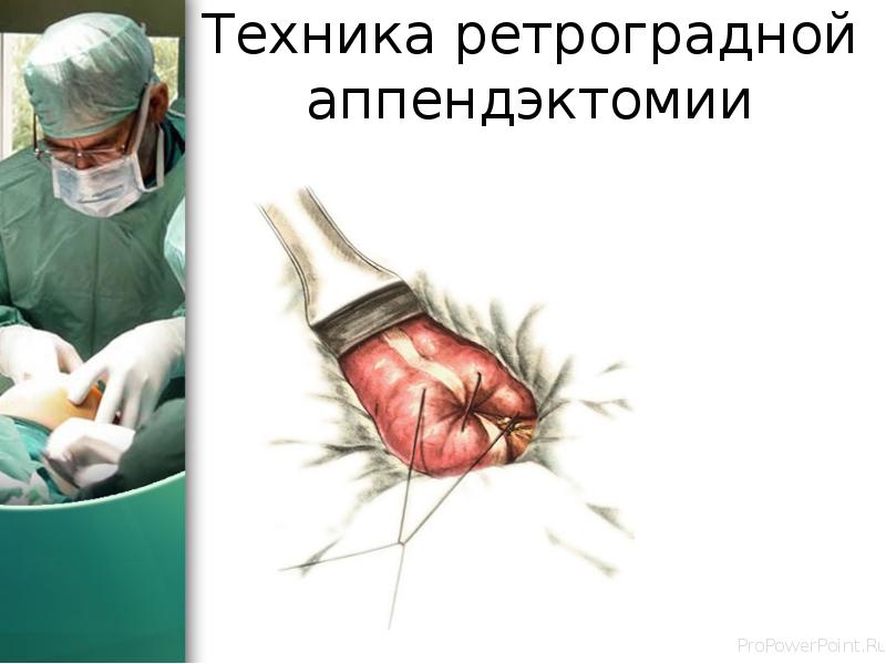 Техника ретроградной аппендэктомии Техника ретроградной аппендэктомии
