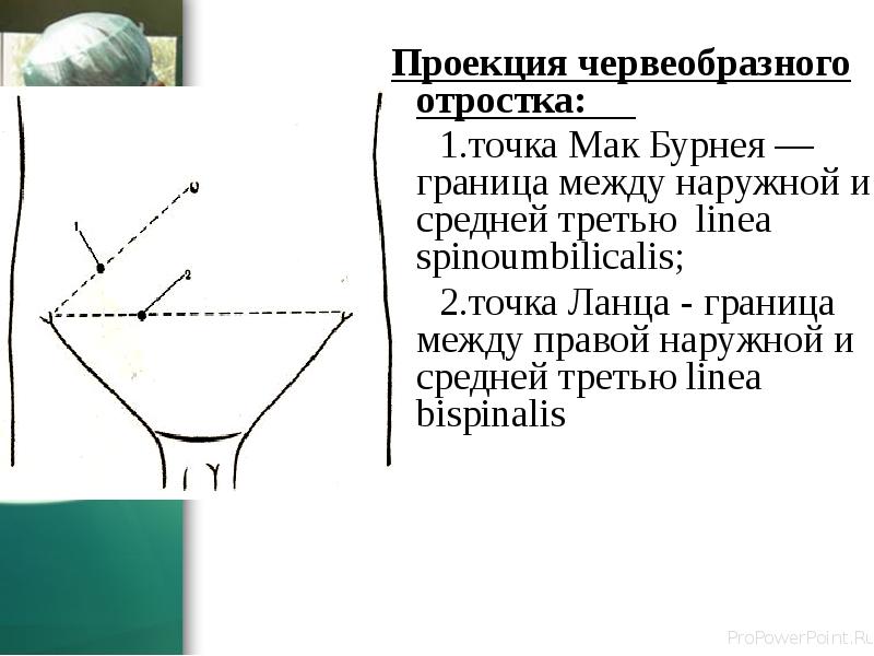 Проекция червеобразного отростка:
Проекция червеобразного отростка: Проекция червеобразного отростка:
Проекция червеобразного отростка: