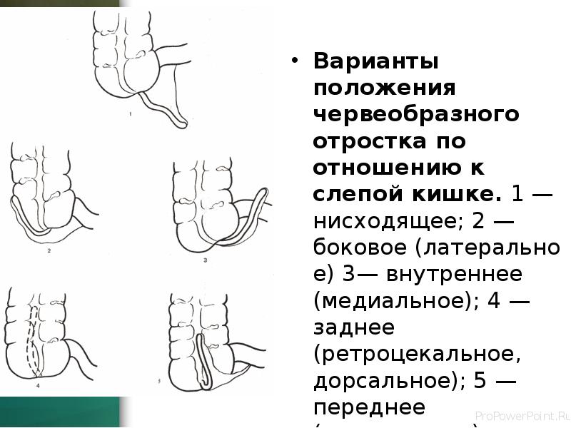 Варианты положения червеобразного отростка по отношению к слепой кишке. 1 — нисходящее; Варианты положения червеобразного отростка по отношению к слепой кишке. 1 — нисходящее;