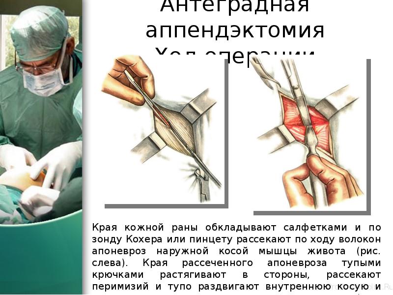 Антеградная аппендэктомия Ход операции
Края кожной раны обкладывают салфетками и по Антеградная аппендэктомия Ход операции
Края кожной раны обкладывают салфетками и по
