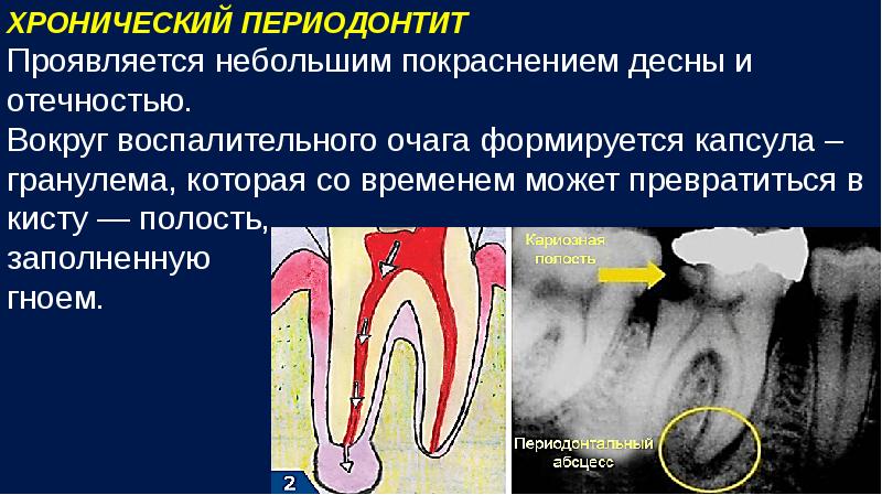 Острый очаговый пульпит презентация