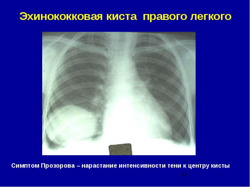 Киста легкого. Эхинококковая киста легкого рентгенограмма. Эхинококковые кисты в легких рентген. Эхинококковые кисты в легких.