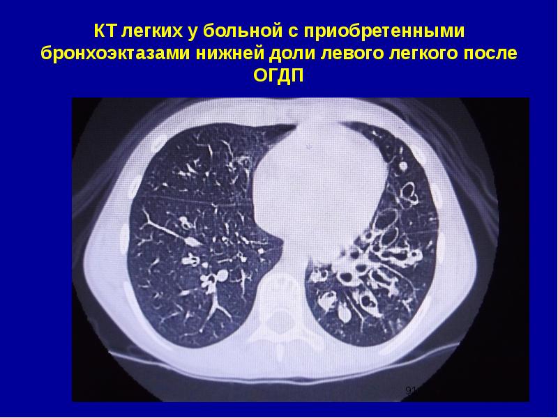 Бронхоэктазы нижней доли