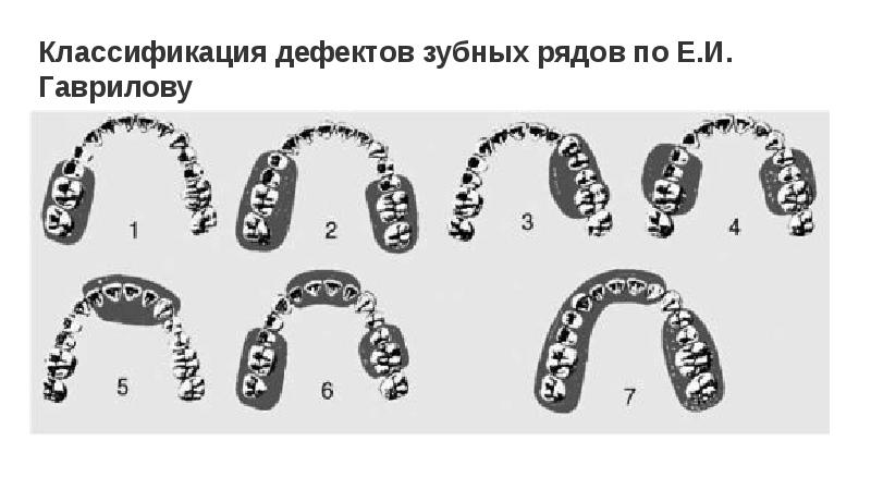 Обследование пациентов с обширными дефектами зубных рядов презентация